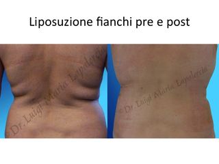 Lipo fiachi prima e dopo
