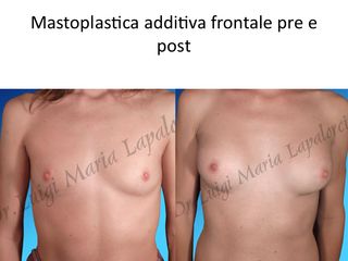 Mastoplastica additiva prima e dopo