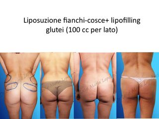 Liposuzione e lipofilling