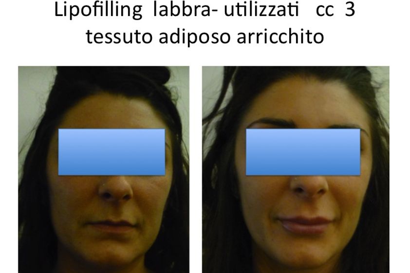 Lipofilling prima e dopo - 745611
