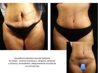 Lipoaddominoplastica prima e dopo
