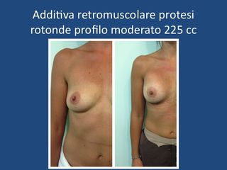 Mastoplastica additiva retromuscolare