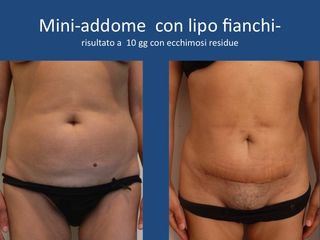 Mini addome con lipo fianchi
