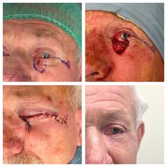 Chirurgia ricostruttiva oculoplastica