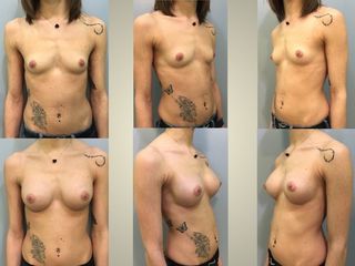 Mastoplastica additiva prima e dopo