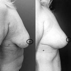 Mastoplastica riduttiva - Dr. Lapalorcia, Studio Di Chirurgia Plastica