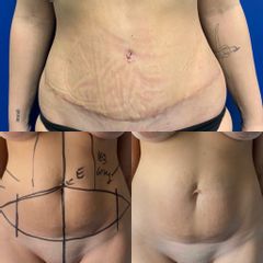 Addominoplastica - Dr. Lapalorcia