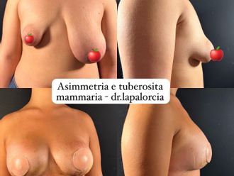 Mastoplastica riduttiva prima e dopo - 876437