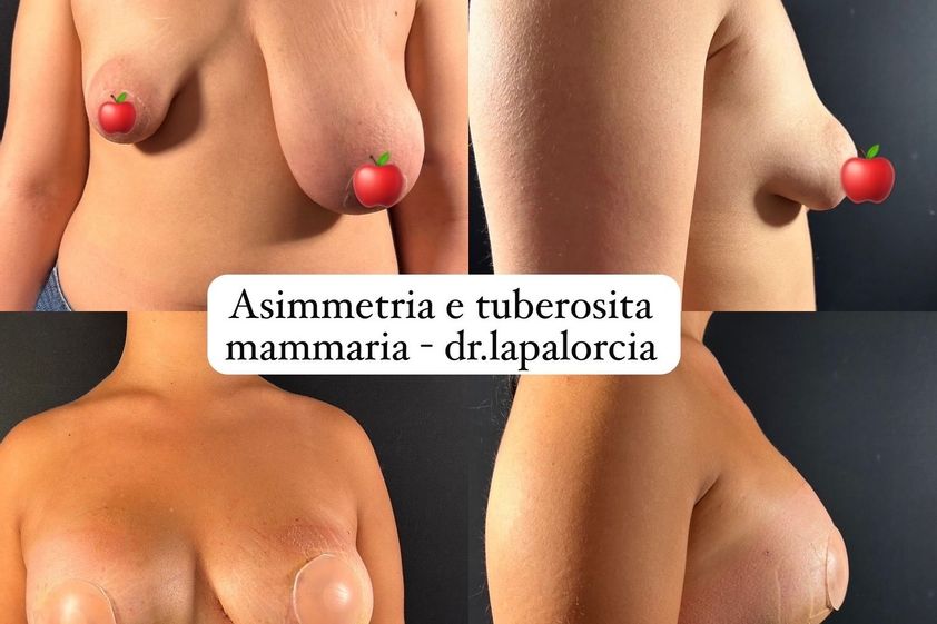 Mastoplastica riduttiva prima e dopo - 876437