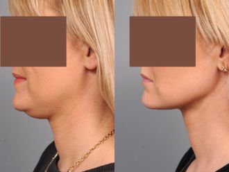 Liposuzione prima e dopo - 876438