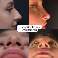 Dr. Luigi Maria Lapalorcia Rinosettoplastica