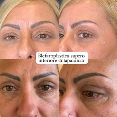 Dr. Luigi Maria Lapalorcia blefaroplastica superiore inferiore