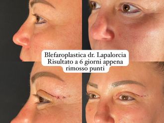 Blefaroplastica prima e dopo - 876442