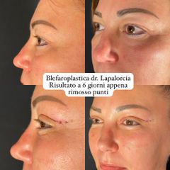 Dr. Luigi Maria Lapalorcia Blefaroplastica superiore