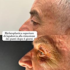 Dr. Luigi Maria Lapalorcia Blefaroplastica superiore
