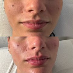 Dr. Luigi Maria Lapalorcia Filler labbra e glow volto con prx