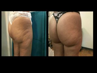 Cellulite prima dopo