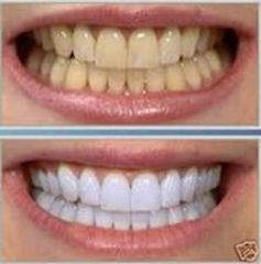 Sbiancamento Denti Prima e Dopo  