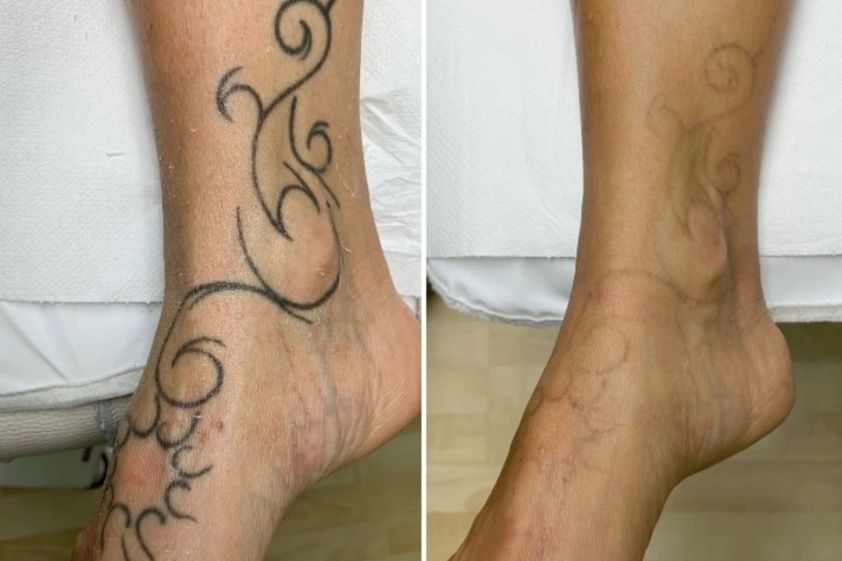 Rimozione tatuaggi prima e dopo - 810525