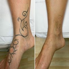 Rimozione tatuaggi - Dott. Mario Marano