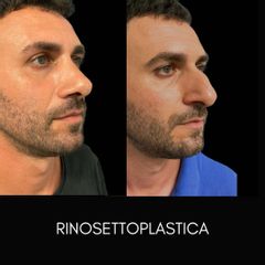Rinoplastica - Dott. Silvio Ascione