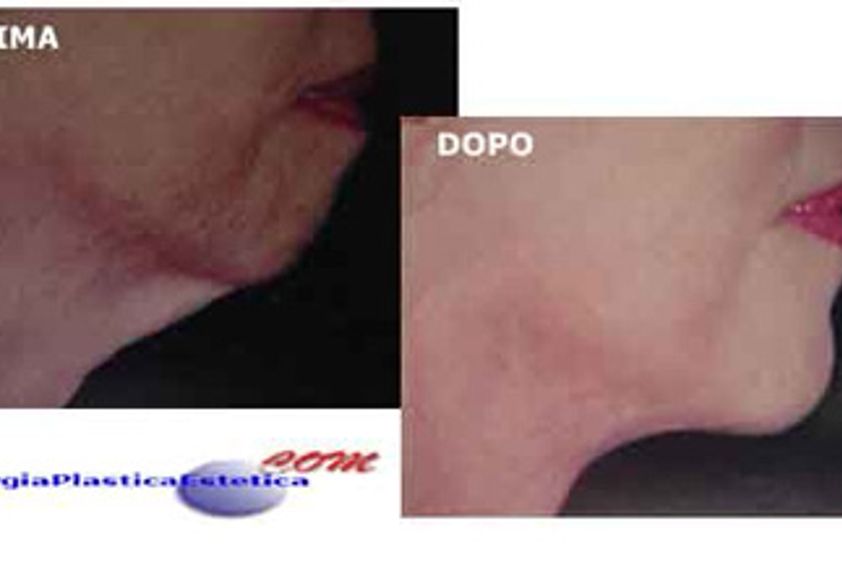 Mentoplastica prima e dopo - 744862