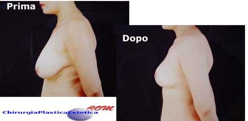 Mastopessi prima e dopo