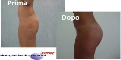 Gluteoplastica prima e dopo