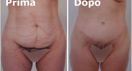 Addominoplastica prima e dopo