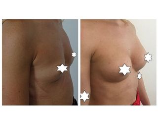 Mastoplastica additiva prima e dopo