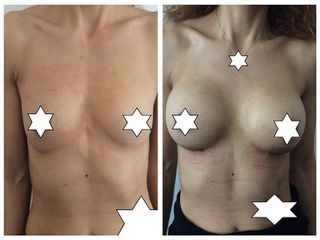 Mastoplastica additiva prima e dopo