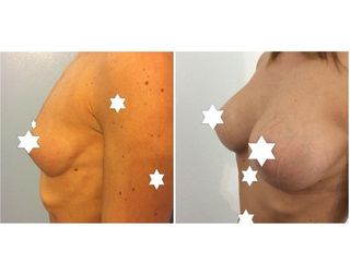 Mastoplastica additiva prima e dopo