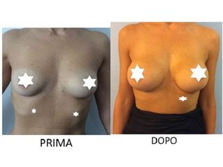 Mastoplastica additiva prima e dopo