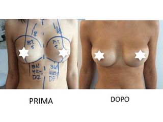 Mastoplastica additiva prima e dopo