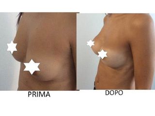 Mastoplastica additiva prima e dopo