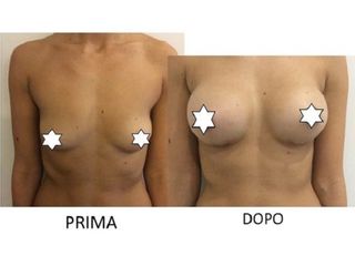 Mastoplastica additiva prima e dopo