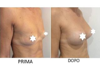 Mastoplastica additiva prima e dopo