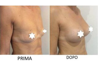 Mastoplastica additiva prima e dopo