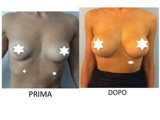 Mastoplastica additiva prima e dopo