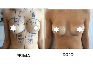 Mastoplastica additiva prima e dopo