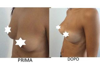Mastoplastica additiva prima e dopo