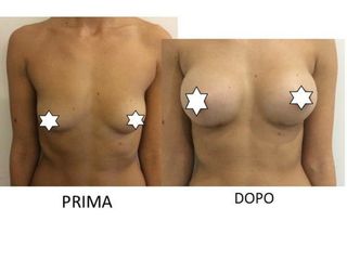 Mastoplastica additiva prima e dopo