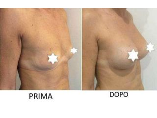 Mastoplastica additiva prima e dopo