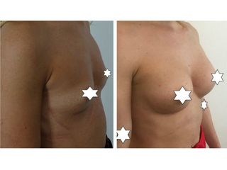 Mastoplastica additiva prima e dopo