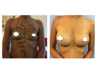 Mastoplastica additiva prima e dopo