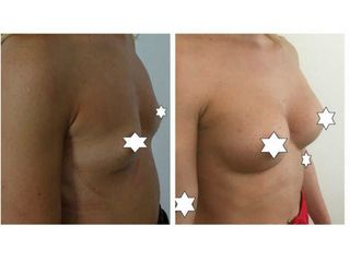 Mastoplastica additiva prima e dopo