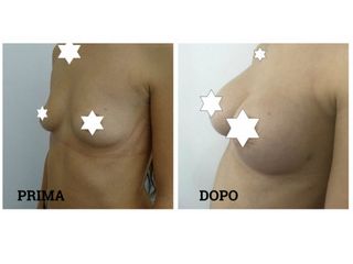 Mastoplastica additiva prima e dopo