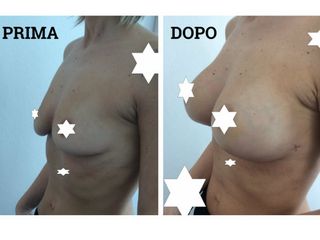 Mastoplastica additiva prima e dopo
