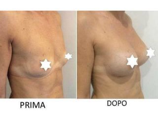 Mastoplastica additiva prima e dopo