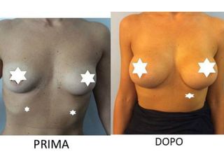 Mastoplastica additiva prima e dopo